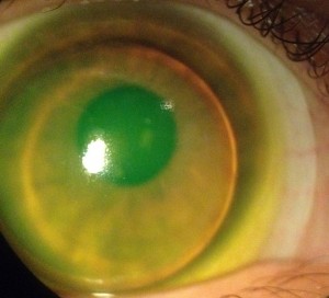 Scleral Lens - Large image