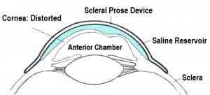 Scleral Lens - Prose Device