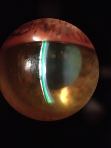 NonWetting-Scleral-Lens_Scleral-Lens-Associates